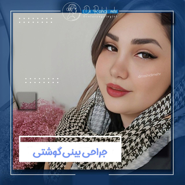 نمونه جراحی بینی گوشتی توسط بهترین جراح بینی گوشتی دزفول - دکتر سهیلا رشیدی مهر