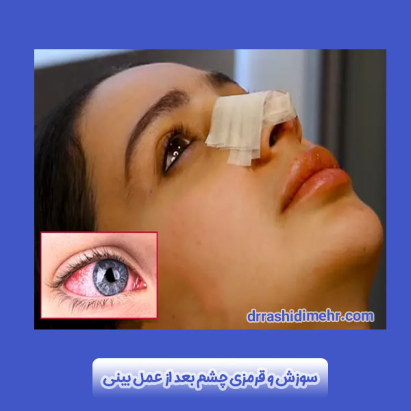 سوزش و قرمزی چشم بعد از عمل بینی