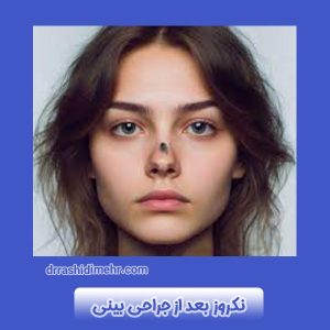 نکروز بعد از جراحی بینی