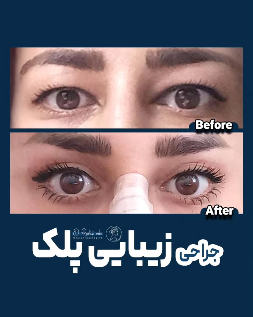 جراحی پلک