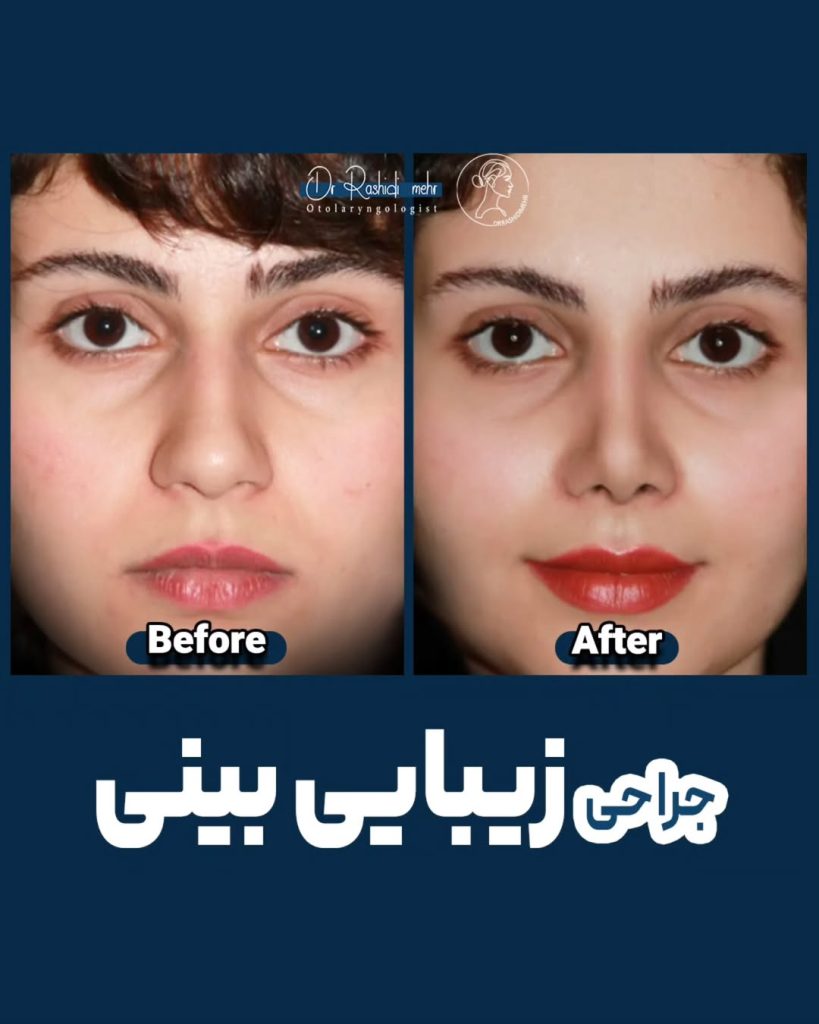 جراحی بینی طبیعی