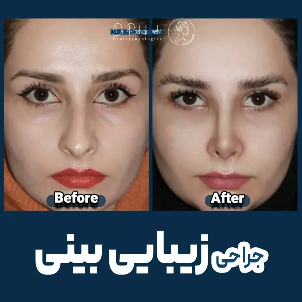 جراحی زیبایی بینی بعد از 2 ماه