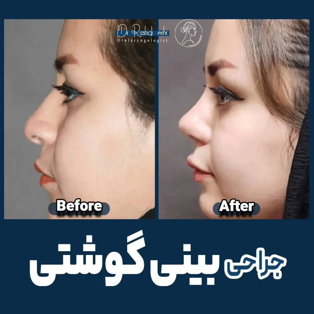 جراحی بینی گوشتی