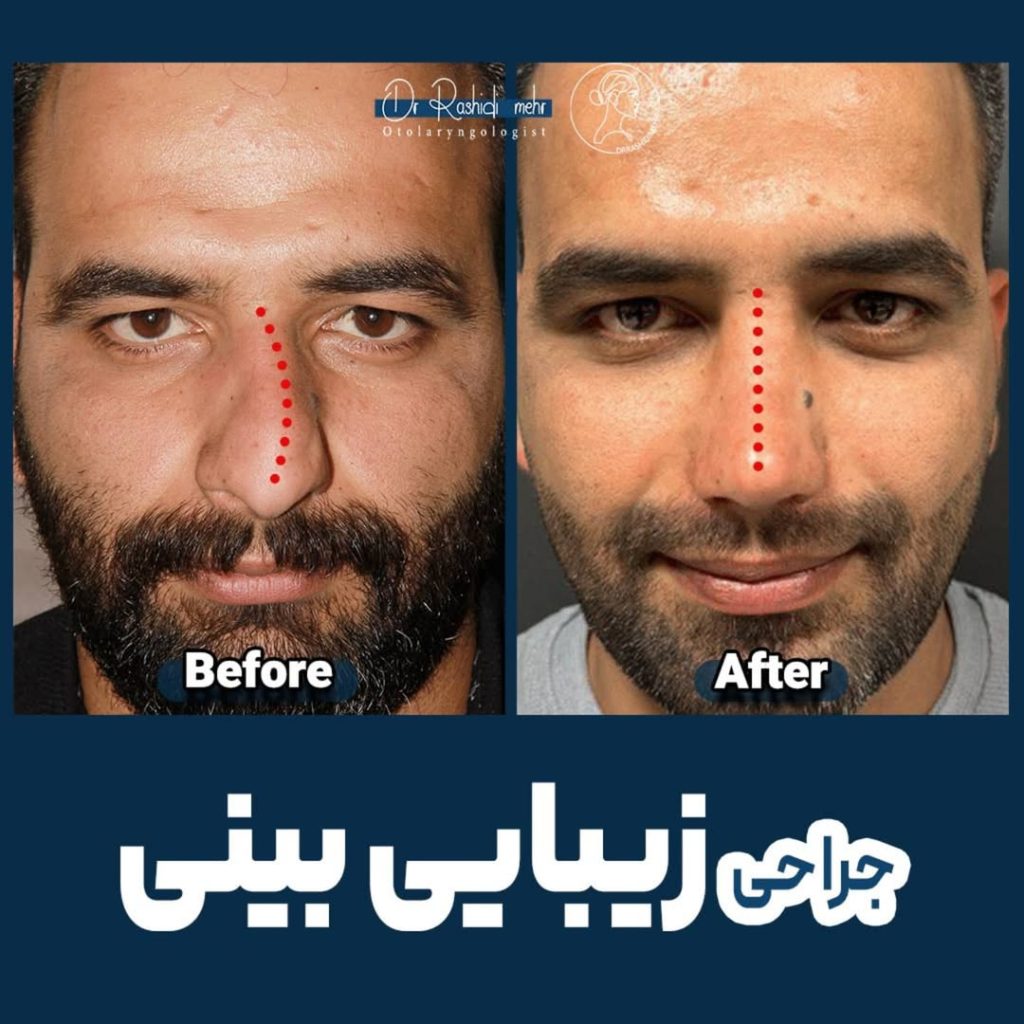 جراحی بینی مردانه