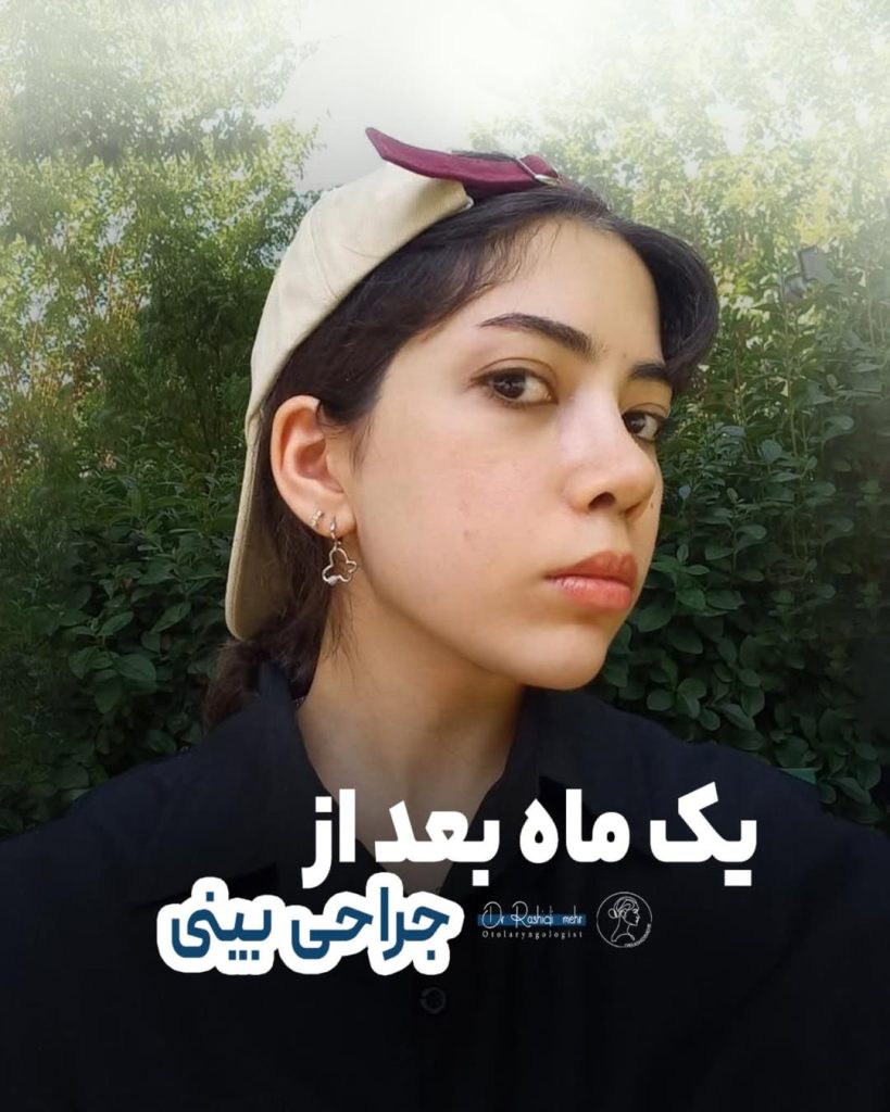 یک ماه بعد از جراحی بینی
