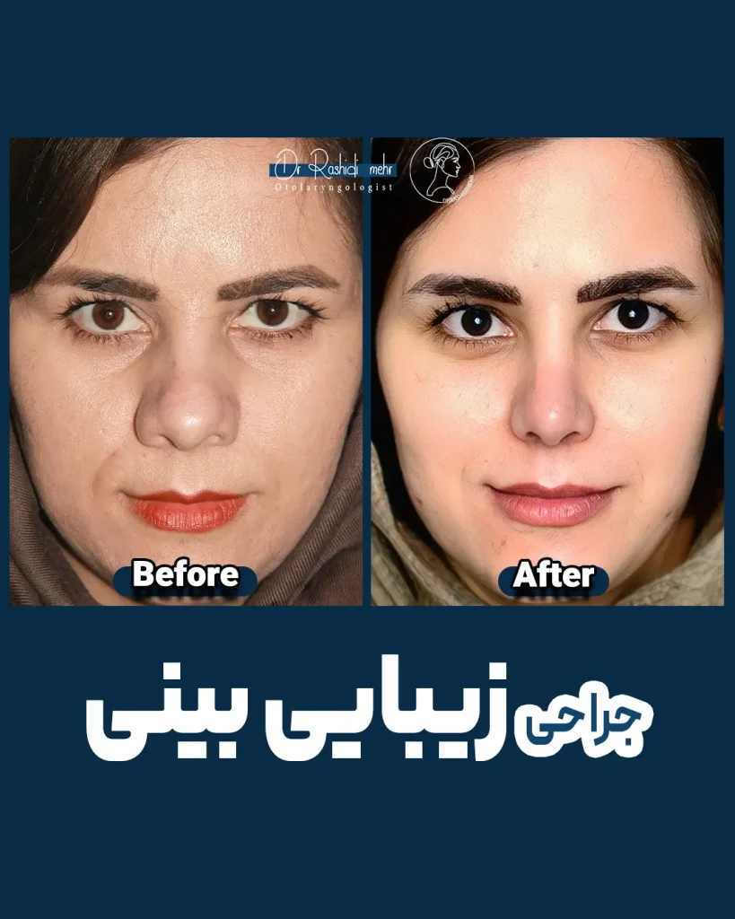 جراحی زیبایی بینی
