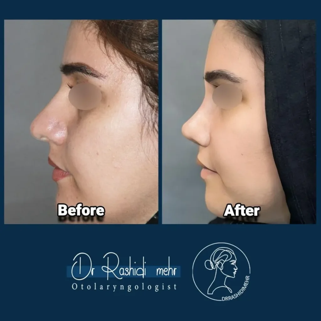 جراحی زیبایی بینی گوشتی
