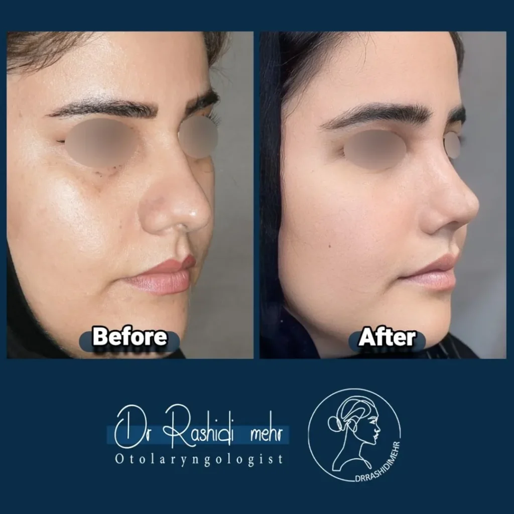 جراحی زیبایی بینی گوشتی