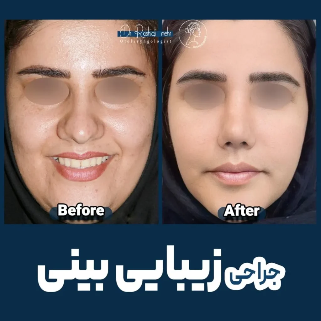 جراحی زیبایی بینی گوشتی