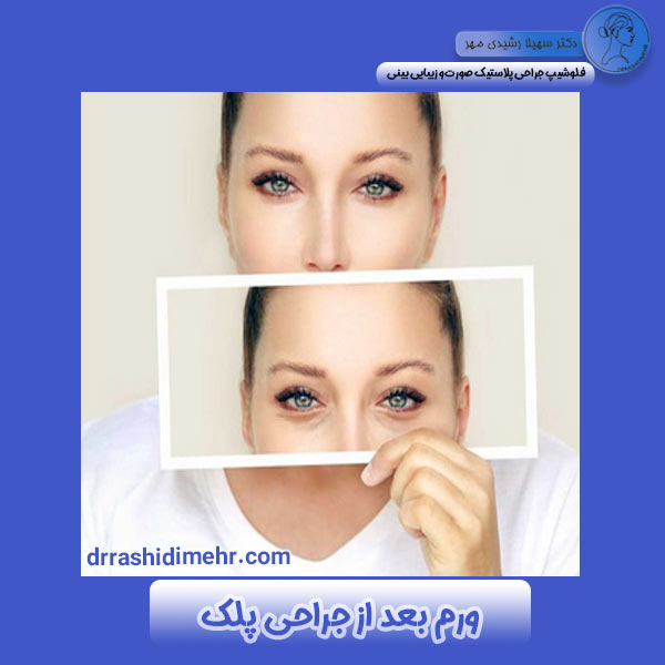 ورم بعد از جراحی پلک