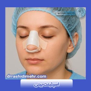 اسپلینت بینی چیست و کاربردهای آن