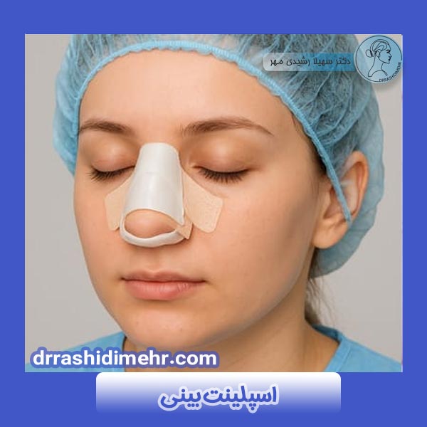 اسپلینت بینی چیست و کاربردهای آن