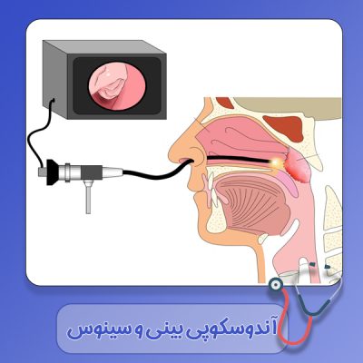 آندوسکوپی بینی و سینوس در دزفول - دکتر رشیدی مهر